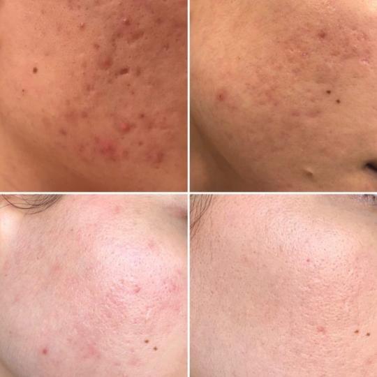 Perfect body beauty bar #zagreb Dermaroler i dermapen Dermapen exosomi - lice Četiri dolaska /kombi