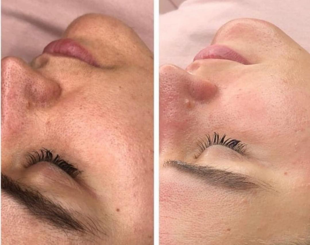 Perfect body beauty bar #zagreb Tretman lica Resurface Diego dalla Palma - kemijski peeling protokol