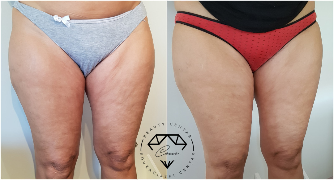 Beauty Centar By Cocco #viskovo Anticelulit masaža