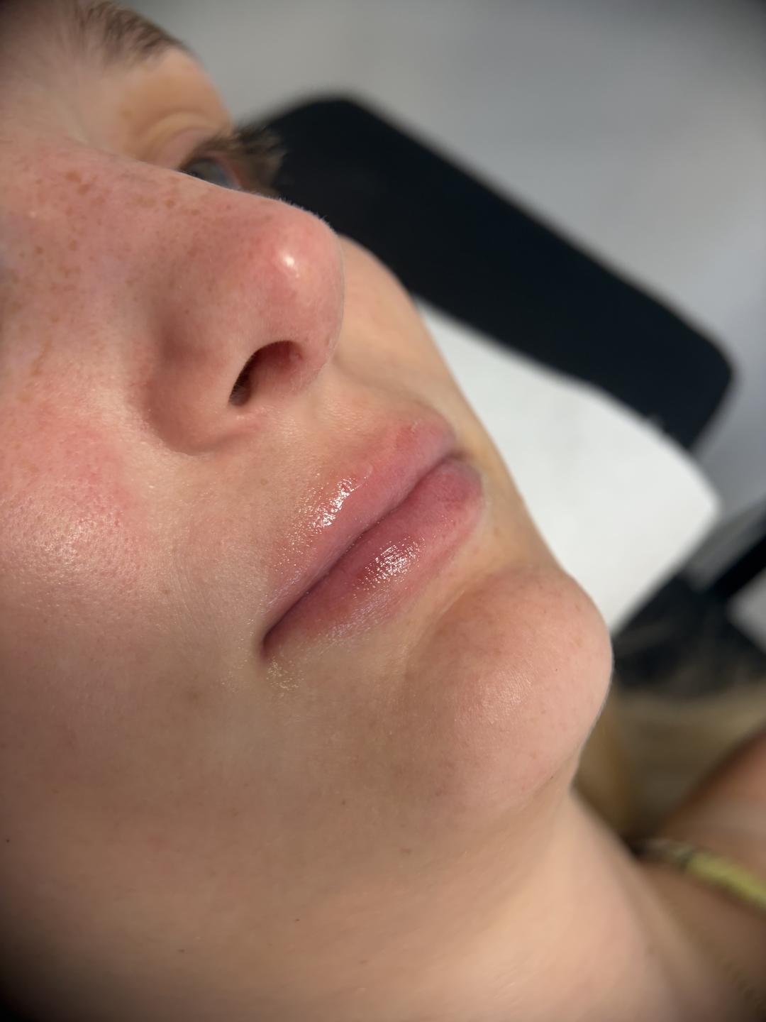 Théa Beauty Spot #zagreb Dermaroler i dermapen Hydra Lips