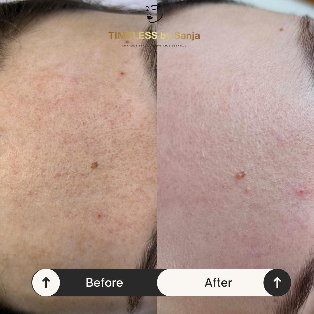 Timeless by Sanja #zagreb Tretman lica KRX - Green sea peel