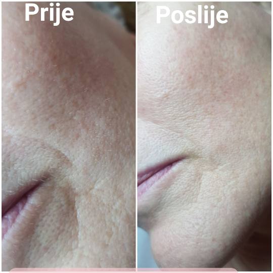 Ten #zagreb Mikrodermoabrazija tretman skidanja mrtvog sloja kože. Reuultat svježa mlađa koža.Pr