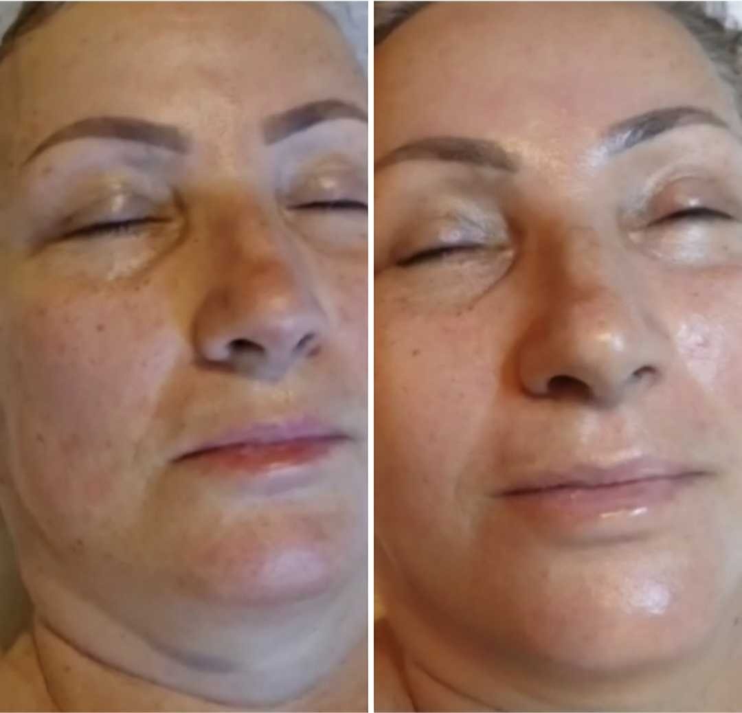 Royal Swiss Beauty #osijek Tretmani protiv bora Royal Swiss Beauty Premium - tretman podmlađivanja lica