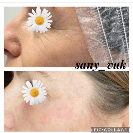 Sany Nails & Cosmetics #zagreb Tretman lica  ACCOR Cosmetics Corrector je nježna alternativa operac