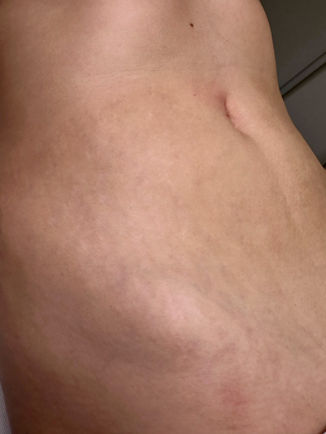 SABRINA STRIJA BEAUTY & SPA #zagreb Tretman ožiljaka Microneedling tijela - 1 regija