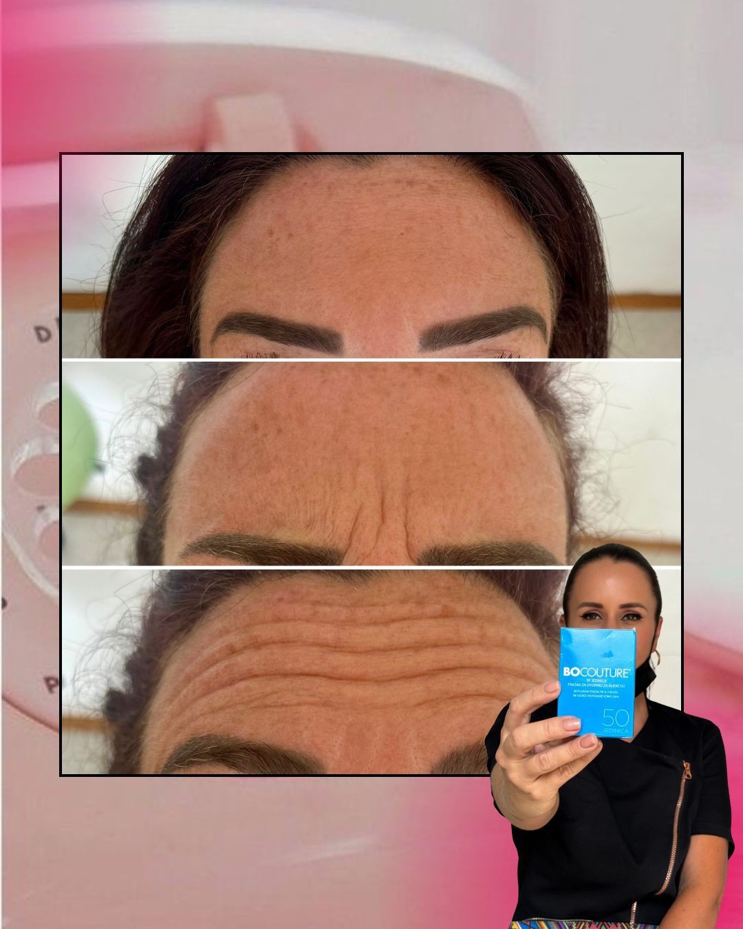 Ordinacija Diana Skorić #rijeka Botox Botox 50