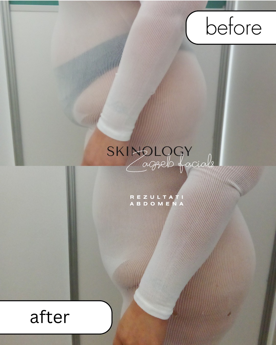 Skinology Zagreb facials #zagreb Tretman lica LPG aparativni anticelulitni tretman - paket od 10 tretmana + 1gratis