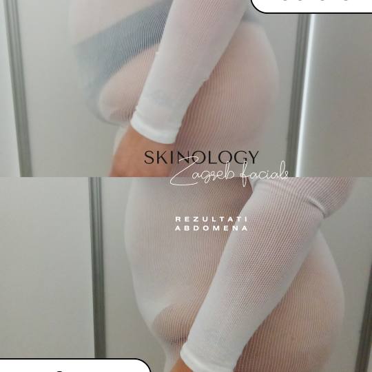 Skinology Zagreb facials #zagreb Tretman lica LPG aparativni anticelulitni tretman - paket od 10 tre