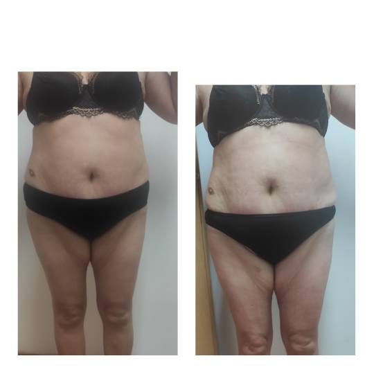 Touch salon #varazdin Anticelulit Brazilska maderoterapija - cijelo tijelo