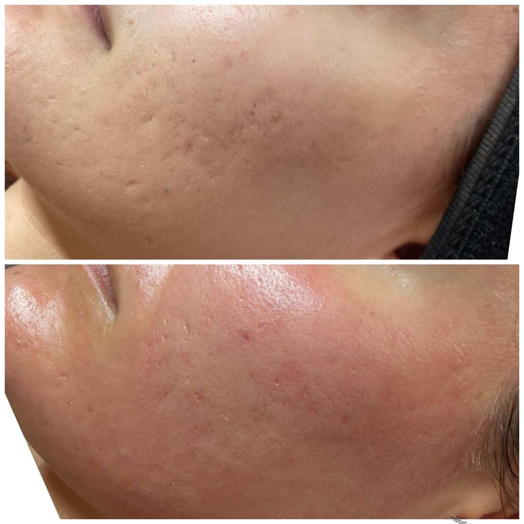 Nefertiti Studio #zagreb Mezoterapija lica Microneedling lica - paket 3 tretmana + 1 gratis