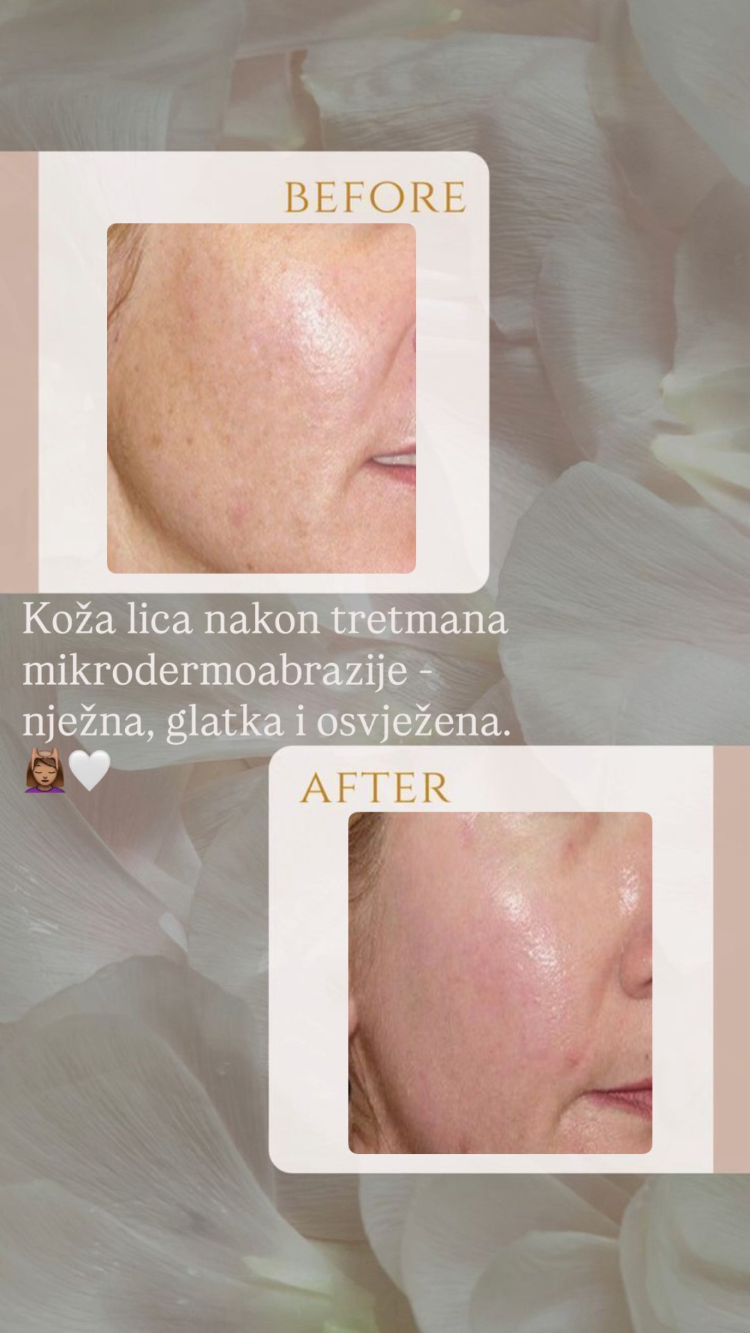 Lunea beauty #zagreb Tretman lica Mikrodermoabrazija lica