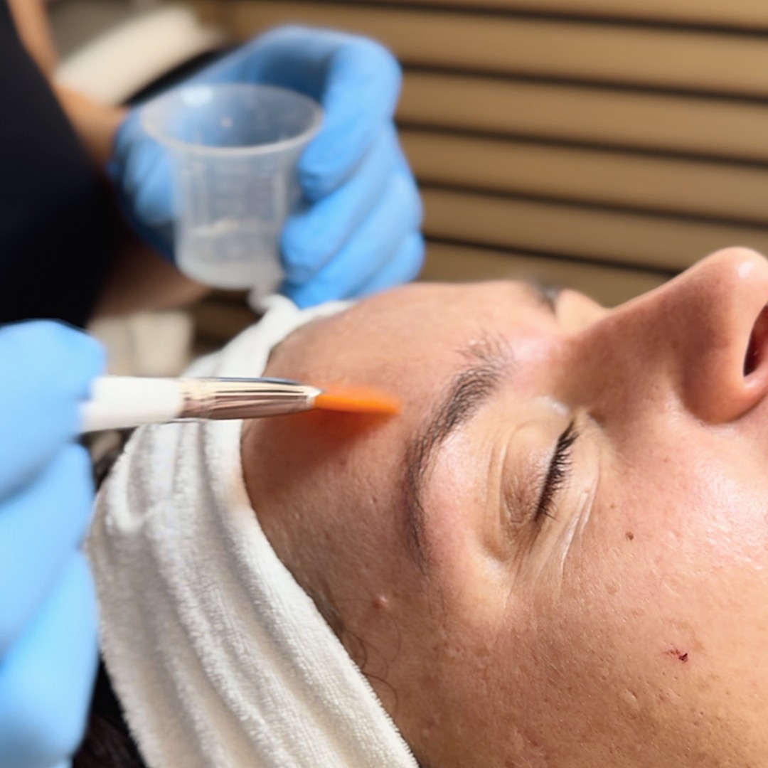 Vanja’s Beautique #zagreb Tretman lica Kemijski piling lica