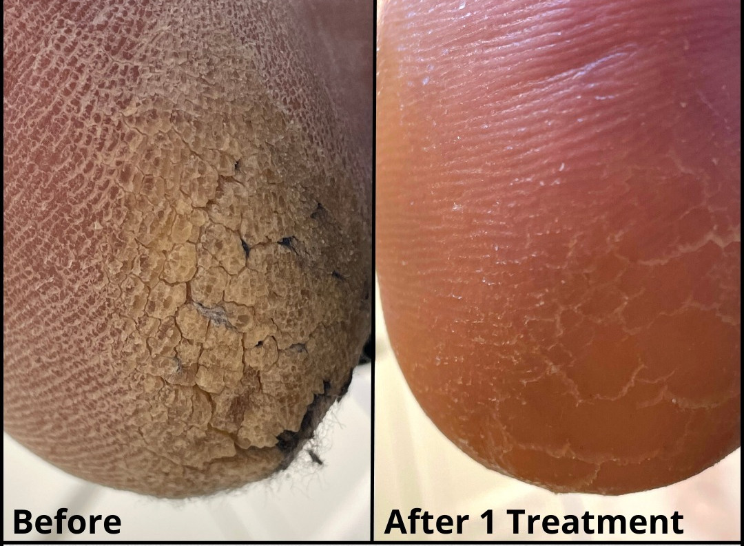 Magnetic #porec Medicinska pedikura Medicinska pedikura