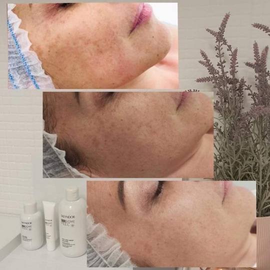 Antiage beauty room Lady Goga #zagreb Tretman lica Kemijski piling