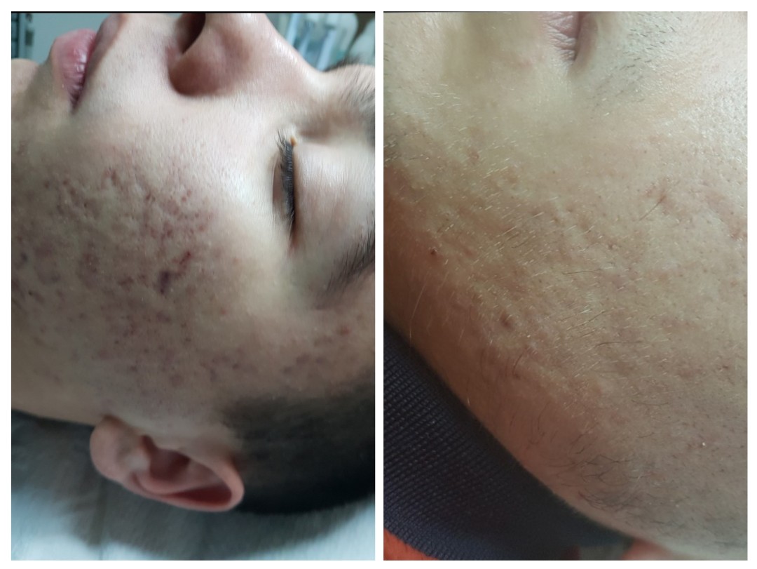 Cosmoderm & Centar Estetica #zagreb Akne Čišćenje lica - nečista / problematična koža (pregled + peeling + čišćenje + maska + masaža + njega)