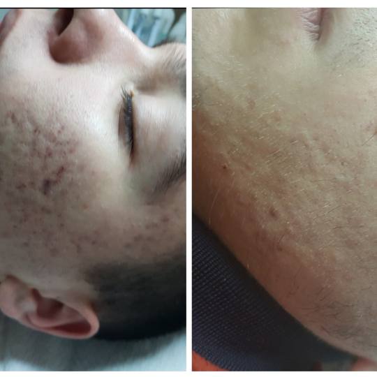 Cosmoderm & Centar Estetica #zagreb Akne Čišćenje lica - nečista / problematična koža (pregled