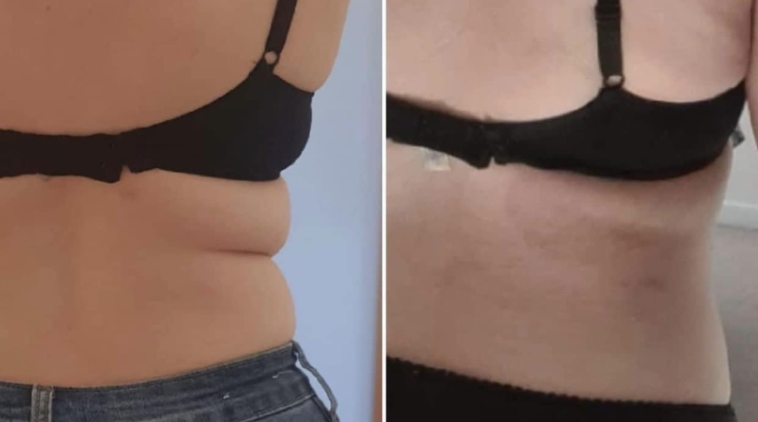 Estetix centar #zagreb Tretmani tijela Lipo laser - paket od 4 tretmana
