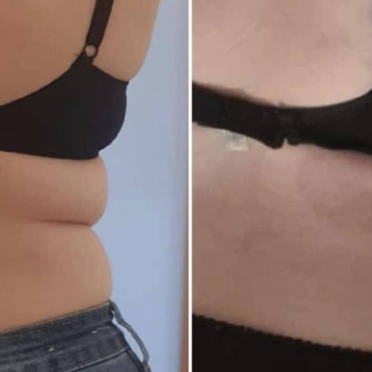 Estetix centar #zagreb Tretmani tijela Lipo laser - paket od 4 tretmana