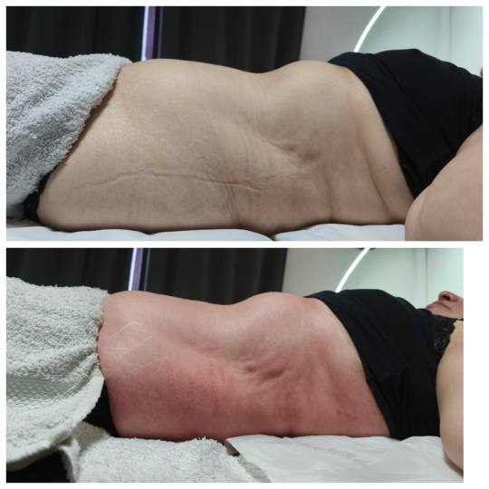 Glitter and glam #zagreb Tretmani tijela Limfno modelovanje - cijelo tijelo