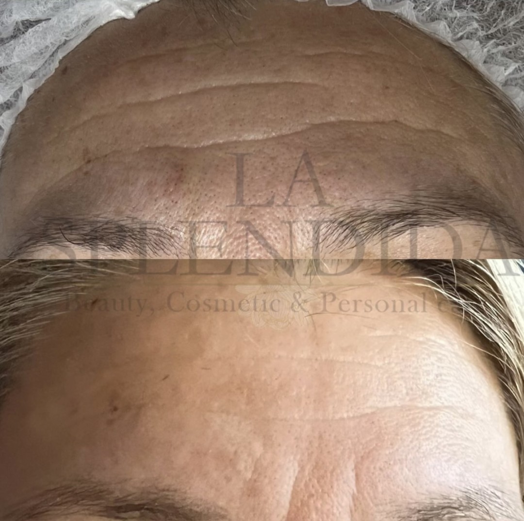 La Splendida #velika-gorica Tretman lica Tretman kologen nitima - lice