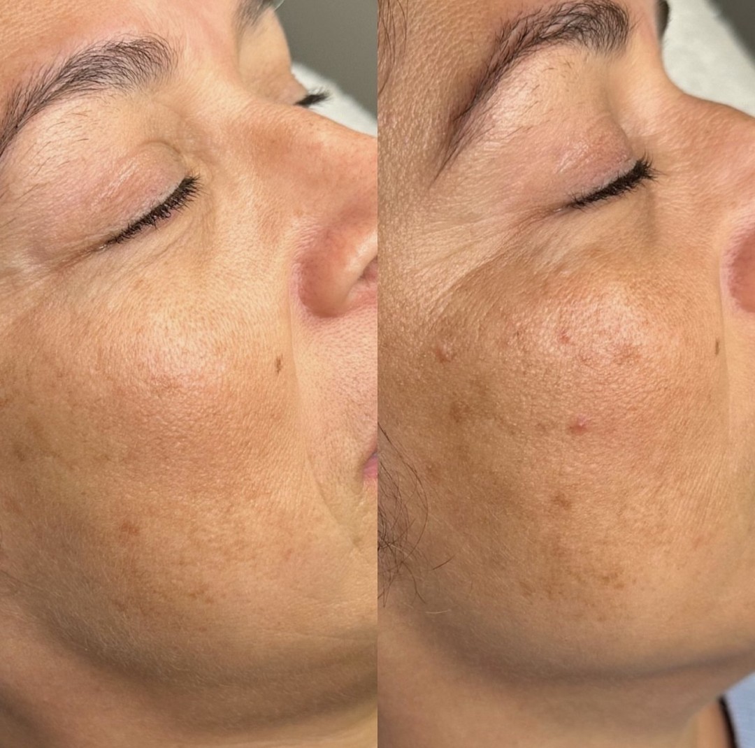 Microneedling lica - Glam Lab, Zagreb Mezoterapija lica Lice Mezoterapija lica, Zagreb, Donji grad - Centar