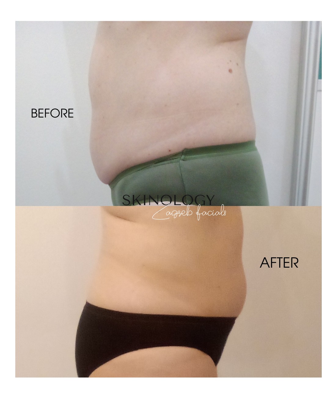 Skinology Zagreb facials #zagreb Tretman lica LPG aparativni anticelulitni tretman - paket od 5 tretmana + 1 gratis