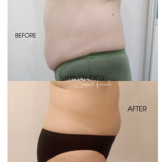 Skinology Zagreb facials #zagreb Tretman lica LPG aparativni anticelulitni tretman - paket od 5 tret