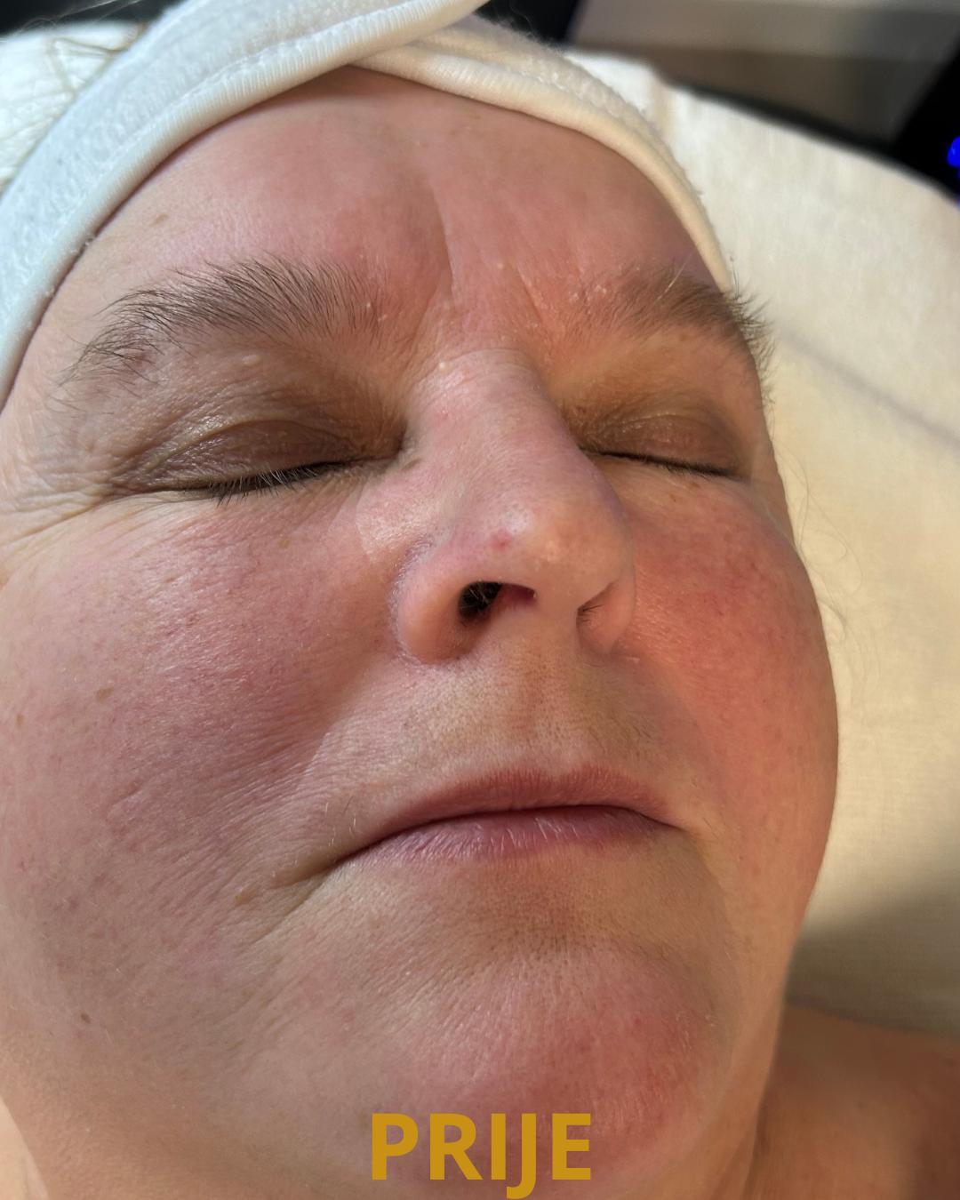 Evi #zagreb Tretman lica Hidrafacial dubinski tretman lica - glam oxy tretman