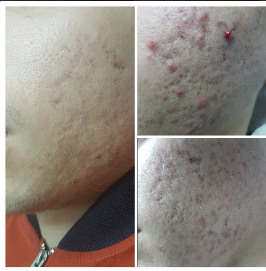 Cosmoderm & Centar Estetica #zagreb Akne Medicinsko mehaničko čišćenje lica - problematična koža s akutnim upalnim stanjima