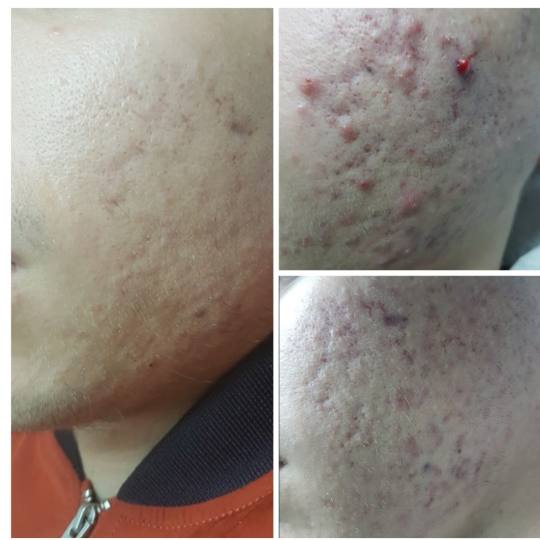 Cosmoderm & Centar Estetica #zagreb Akne Medicinsko mehaničko čišćenje lica - problematična ko