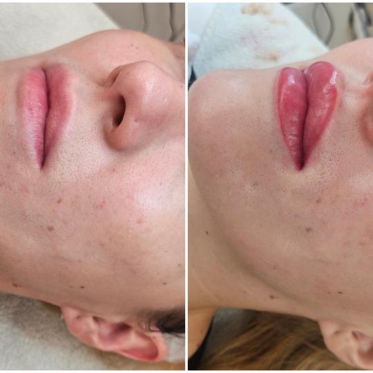 Cosmoderm & Centar Estetica #zagreb Trajna šminka Trajna šminka - usne - lip blush Tretman trajne 