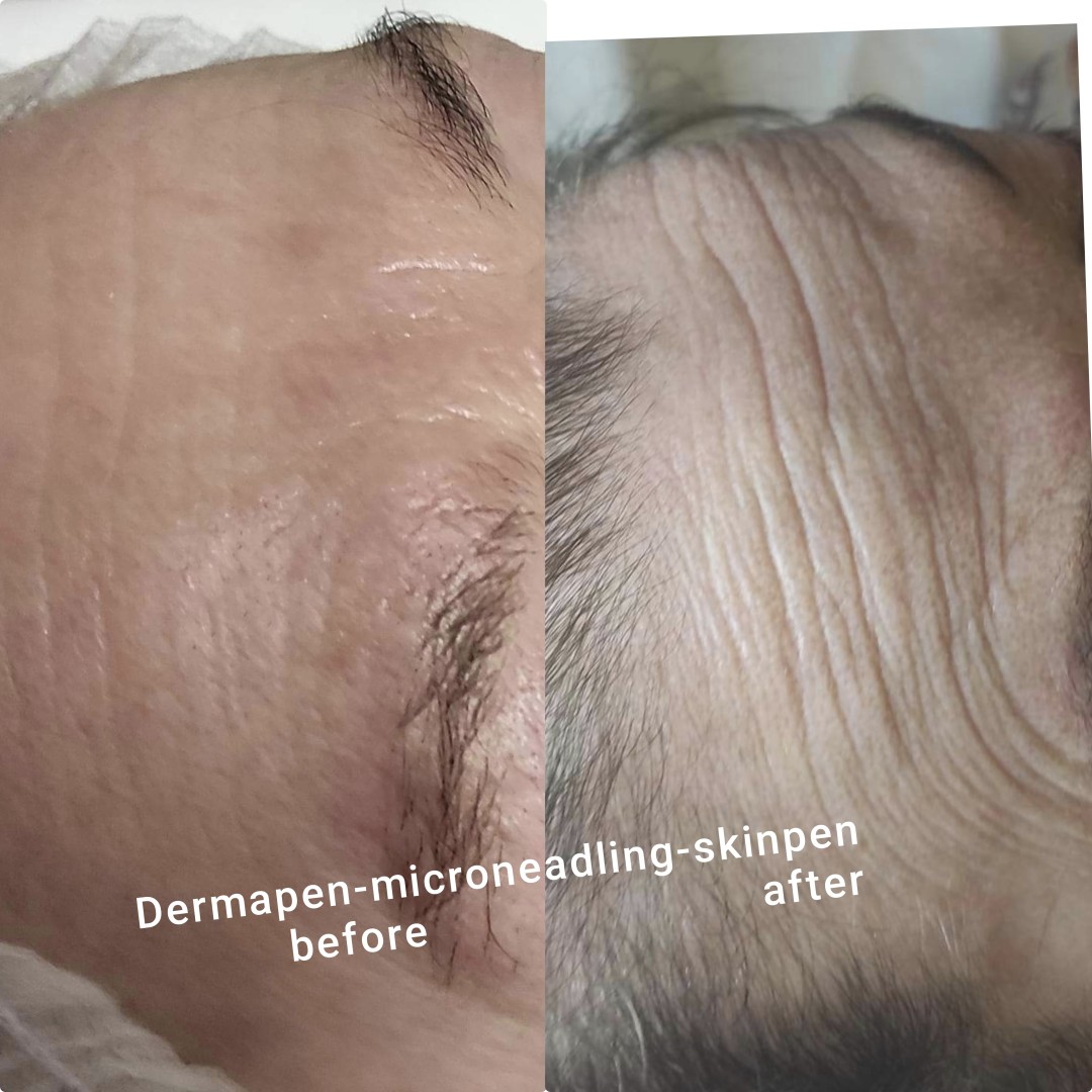 BioLaser Studio Rijeka #rijeka Tretman lica Dermapen aplikacija mezoterapijskih koktela