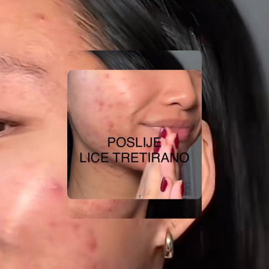 Head Spa #pula Tretman lica Kozmetička njega lica Začepljene pore i nakupljena nečistoća mogu do