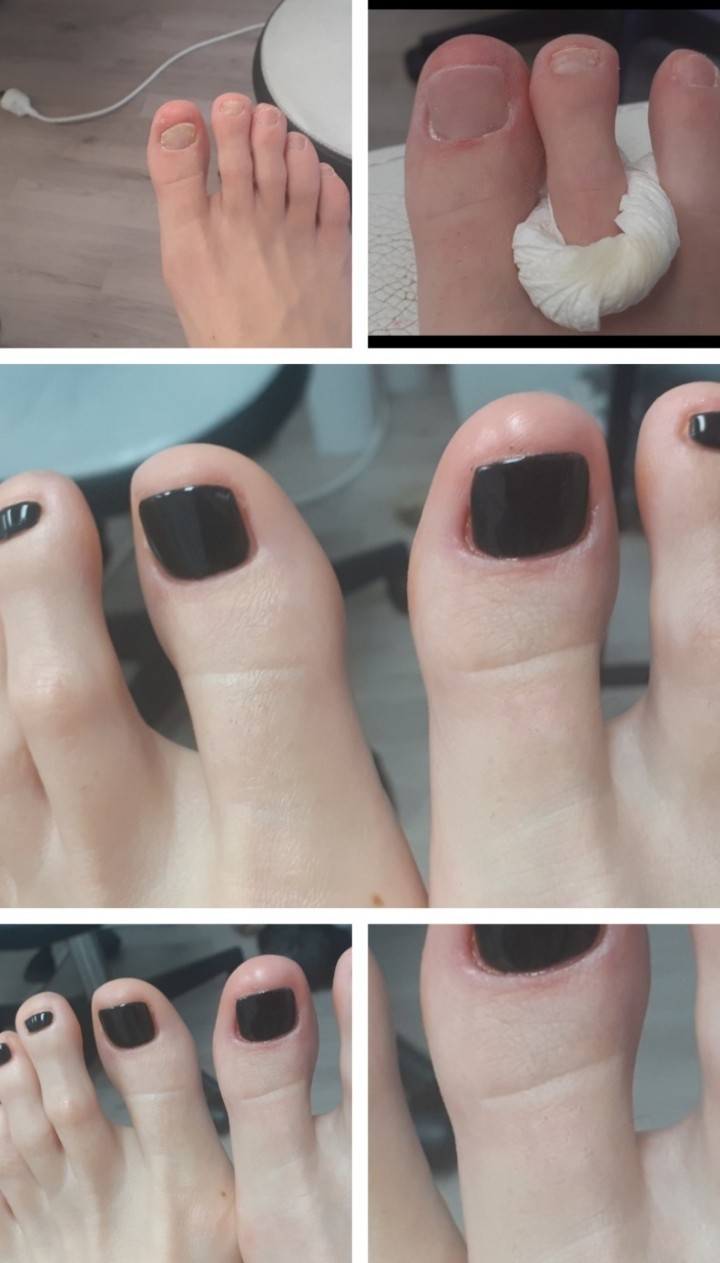 Cosmoderm & Centar Estetica #zagreb Medicinska pedikura Medicinska pedikura + trajni lak - složeni slučajevi