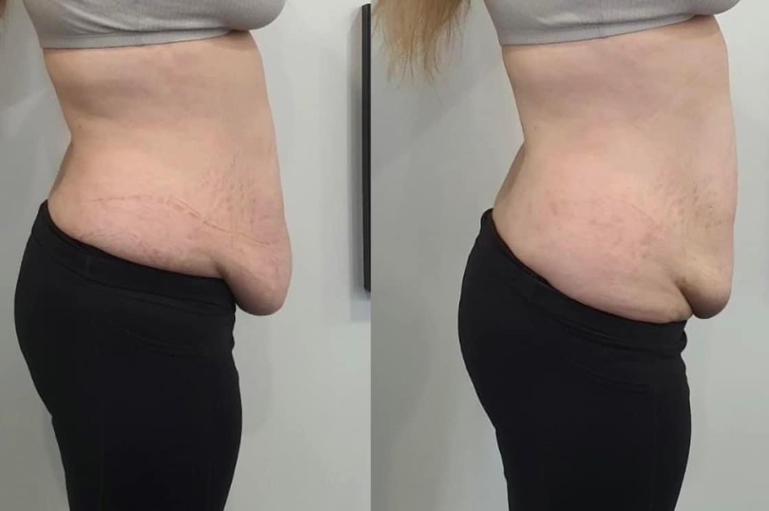 Estetix centar #zagreb Tretmani tijela Mega paket tretmana