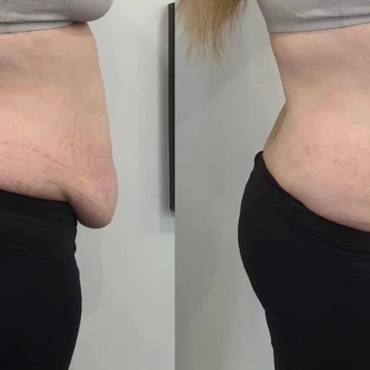 Estetix centar #zagreb Tretmani tijela Mega paket tretmana Bez obzira na normalnu tjelesnu težinu k