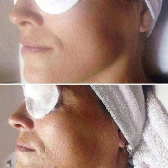 Antiage beauty room Lady Goga #zagreb Tretman lica Kemijski piling