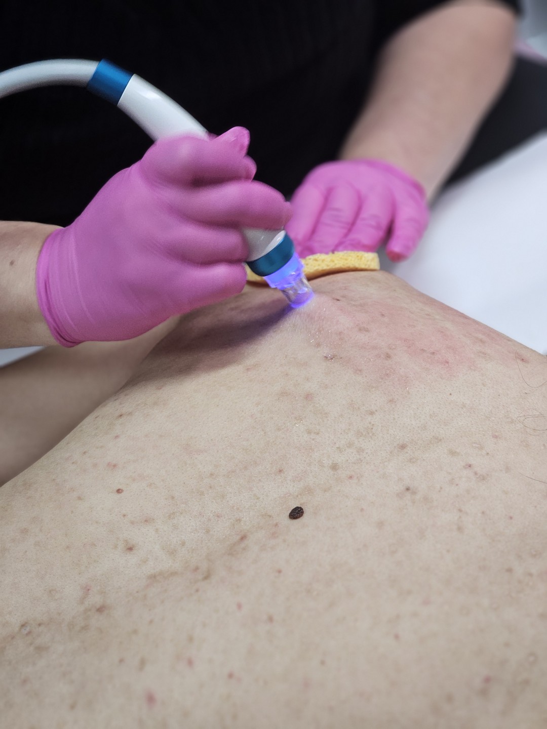 S M Beauty Bloom #zadar Tretman lica Hydra tretman - leđa