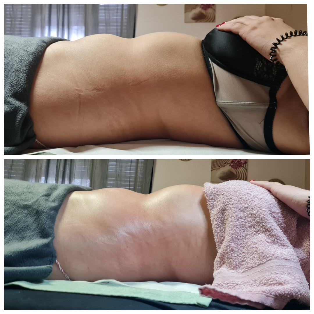 Glitter and glam #zagreb Tretmani tijela Limfno modelovanje - cijelo tijelo