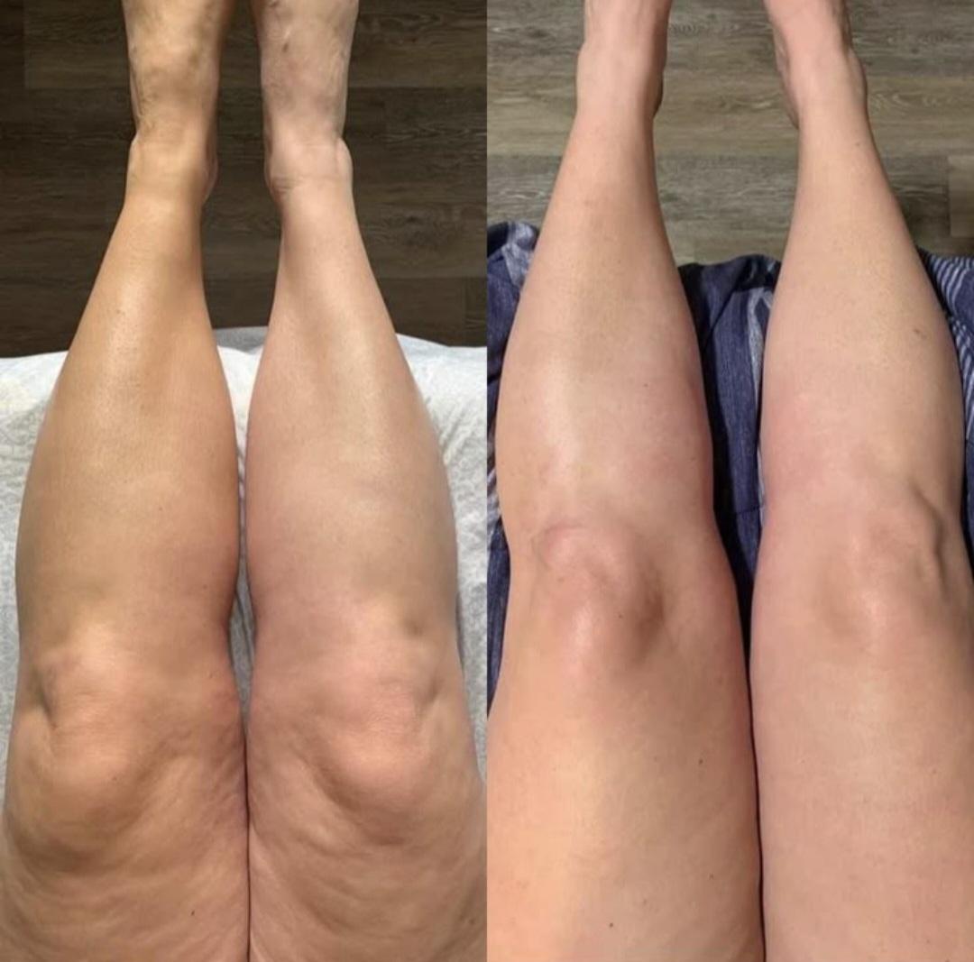 Aura Bliss #zagreb Anticelulit masaža Anticelulitna masaža