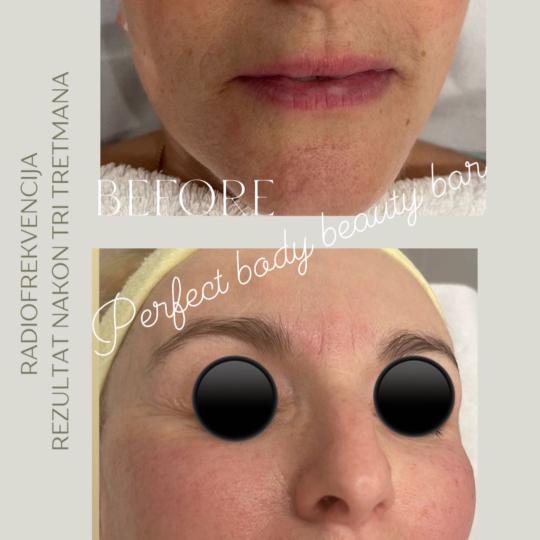 Perfect body beauty bar #zagreb Tretman lica RF lica + vrata + dekoltea Radiofrekvencija lica izvodi