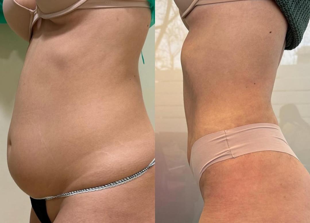 Perfect body beauty bar #zagreb Body wrap / pakovanja Deluxe shape ultrazvučna kavitacija - 60 minuta