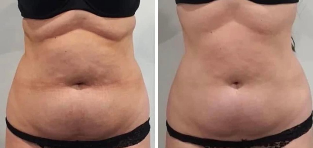 Estetix centar #zagreb Tretmani tijela Emsculpt tretman tijela - paket od 4 tretmana