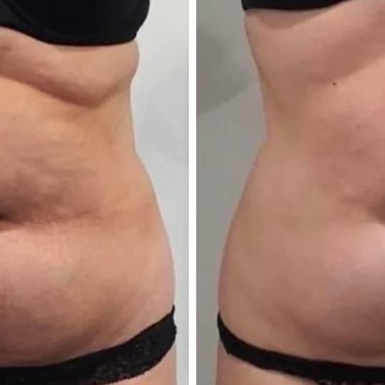 Estetix centar #zagreb Tretmani tijela Emsculpt tretman tijela - paket od 4 tretmana ✅EMSc/ tretma