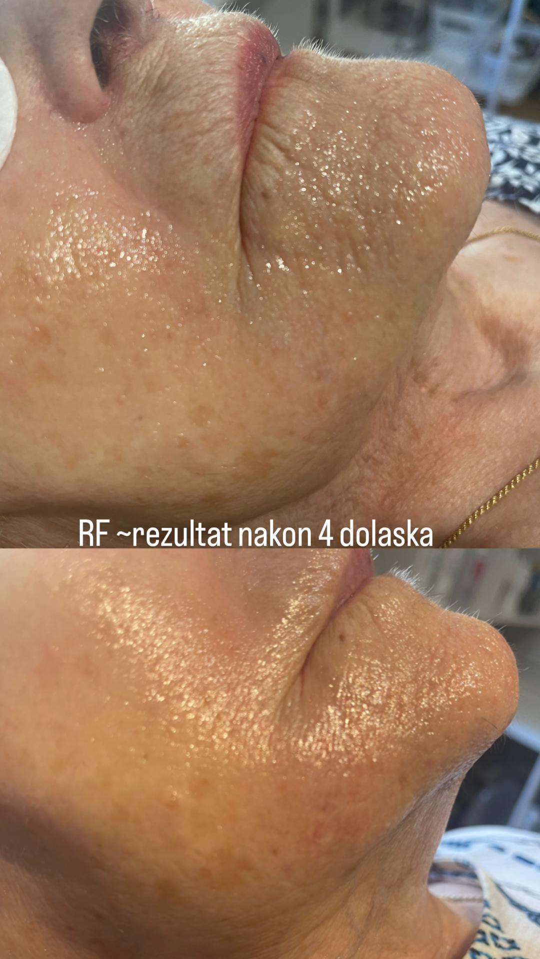 Perfect body beauty bar #zagreb Tretman lica RF lica + vrata + dekoltea
