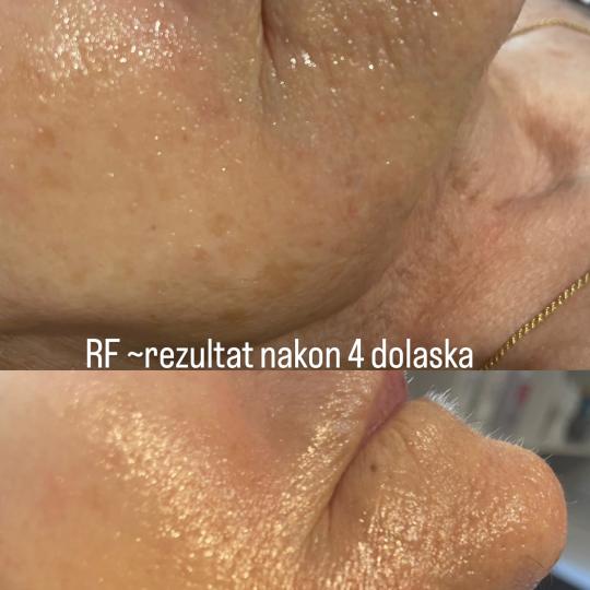 Perfect body beauty bar #zagreb Tretman lica RF lica + vrata + dekoltea