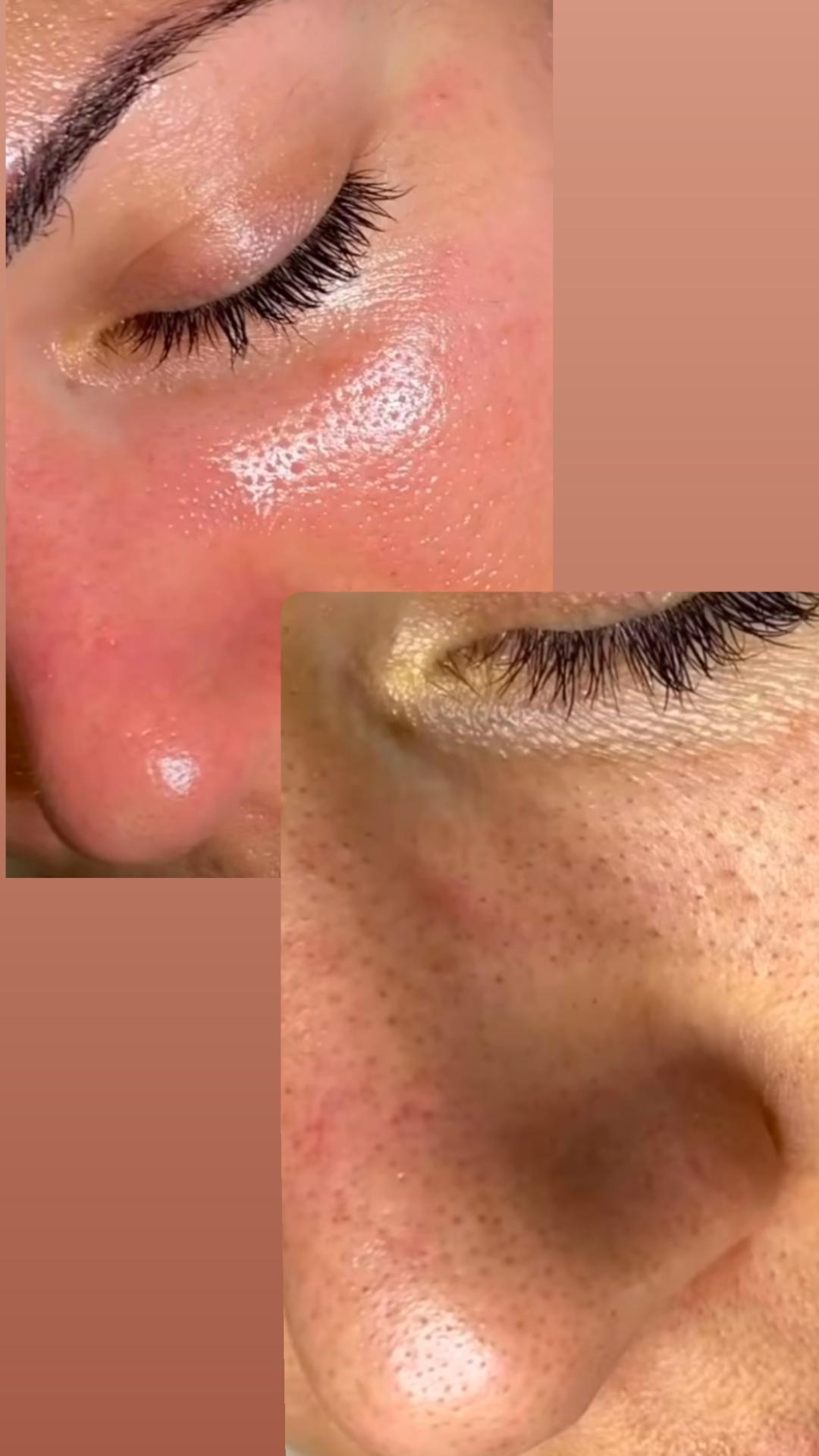 Perfect body beauty bar #zagreb Tretman lica Resurface Diego dalla Palma - kemijski peeling protokol
