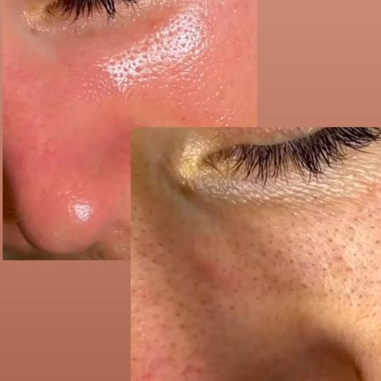 Perfect body beauty bar #zagreb Tretman lica Resurface Diego dalla Palma - kemijski peeling protokol