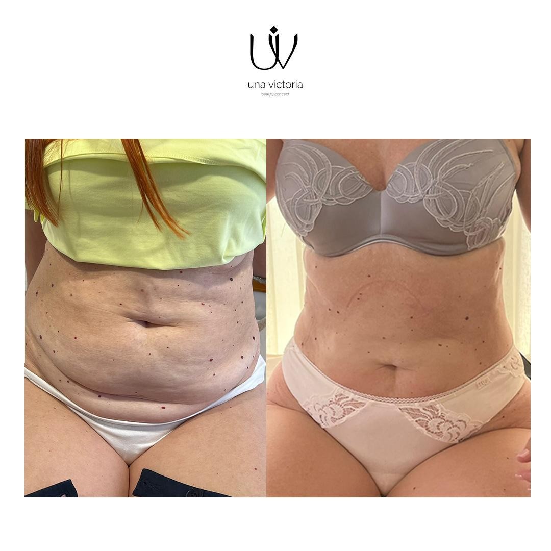 Una Victoria beauty concept #zadar Tretmani tijela Lemon bottle tretman