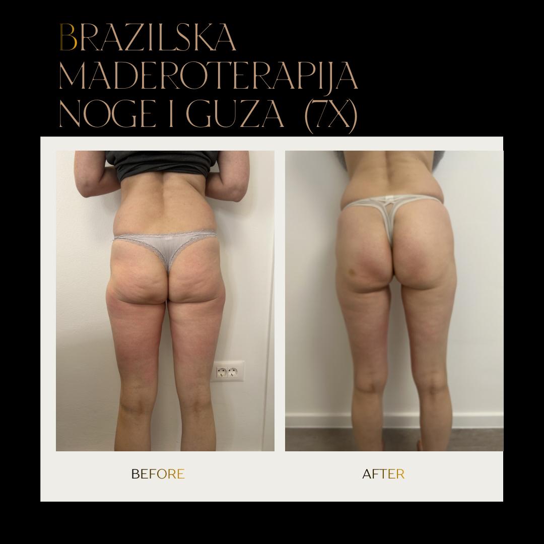 Evi #zagreb Anticelulit masaža Brazilska maderoterapija nogu - paket od 10 tretmana